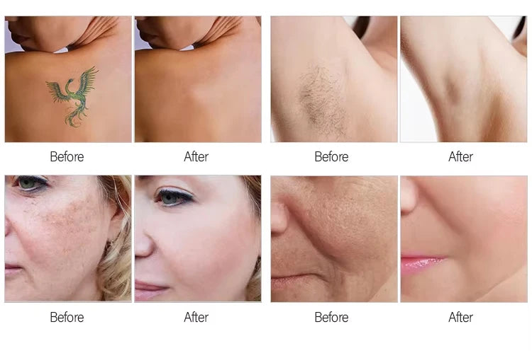 2025 Professional 2 in 1 Laser Hair Removal Machine Picosecond Q Switch ND YAG 1064NM Tattoo Removal 3 Waves Device