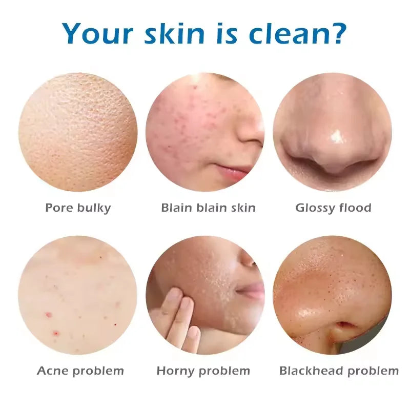 Sea Salt Body Acne Removal Soap Treatment Face Butt Back Acne Marks Smooth Repair Chicken Skin Moisturizing Whitening Skin Care