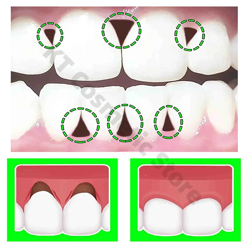 Rapid Repairing Gum Atrophy Toothpaste Effectively Relieve Dental Allergies Deep Cleaning Tooth Caries Damaged Teeth Care Serum