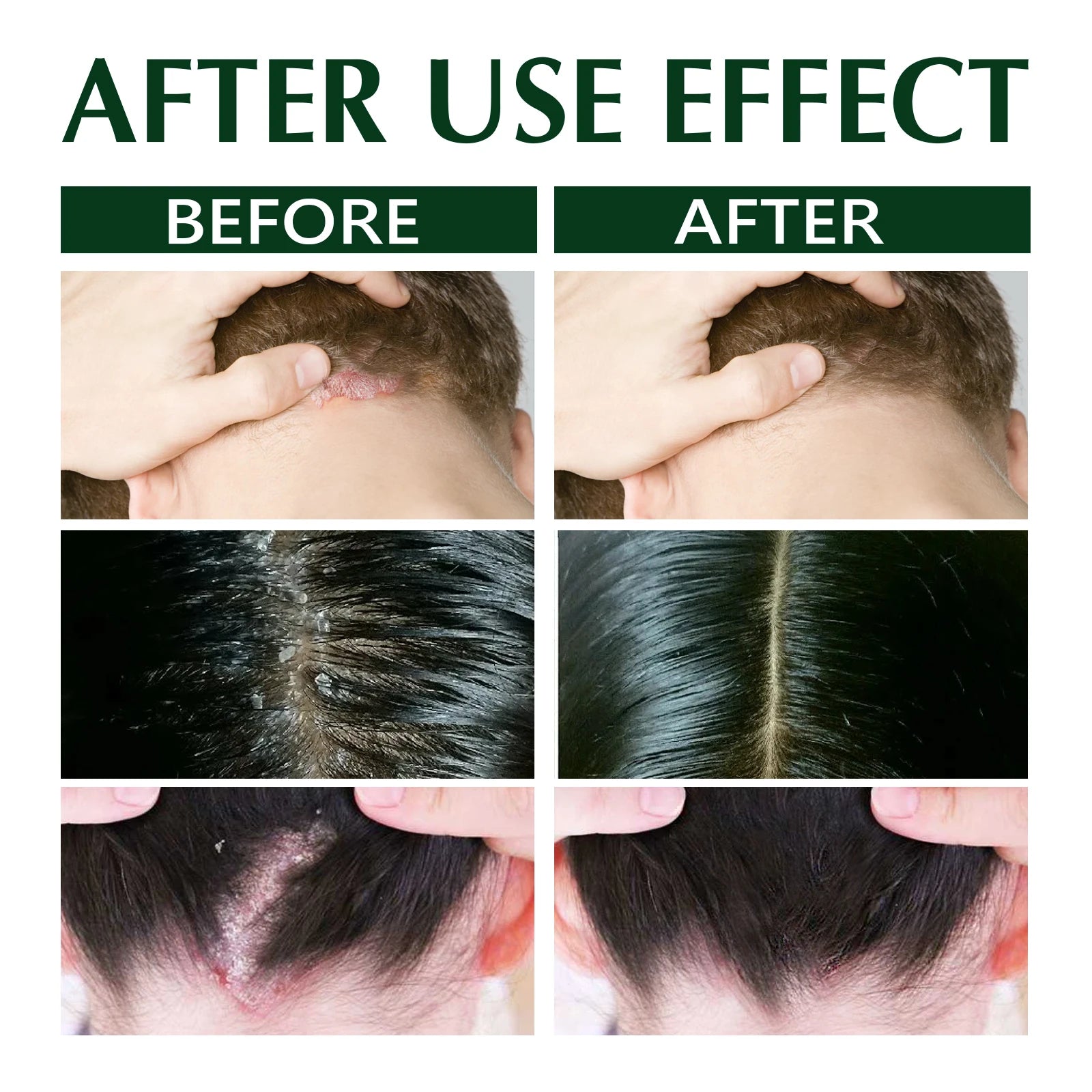 Anti-Dandruff Shampoo, Moisturizing &amp; Scalp Restoration