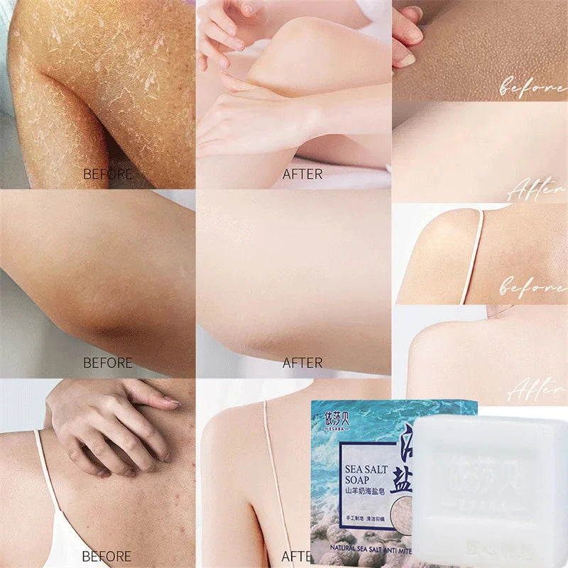 Sea Salt Body Acne Removal Soap Treatment Face Butt Back Acne Marks Smooth Repair Chicken Skin Moisturizing Whitening Skin Care