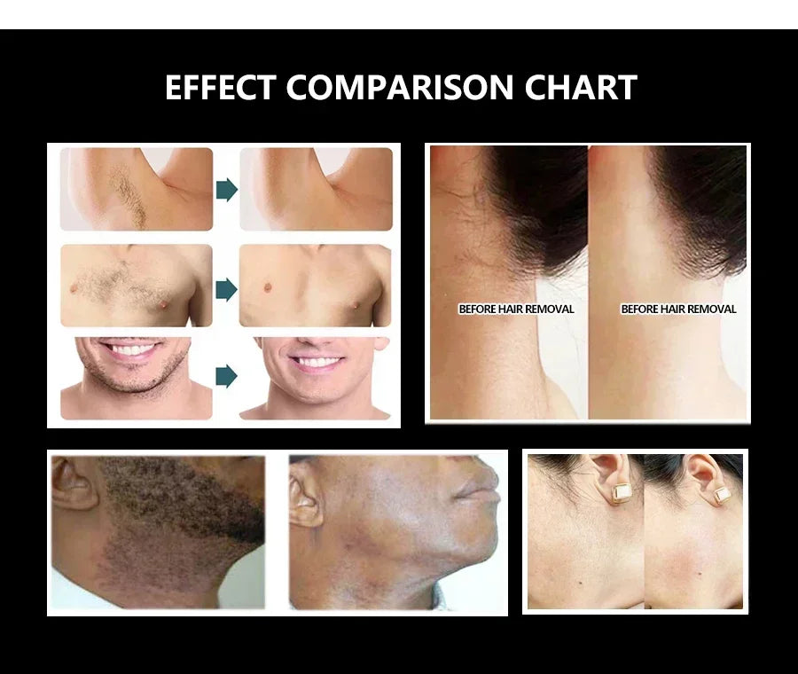 808nm Alexandrite Professional Soprano Diode Ice Titanium Laser Body Hair Removal Machine 4 Wave Device Permanent CE Woman 4000w