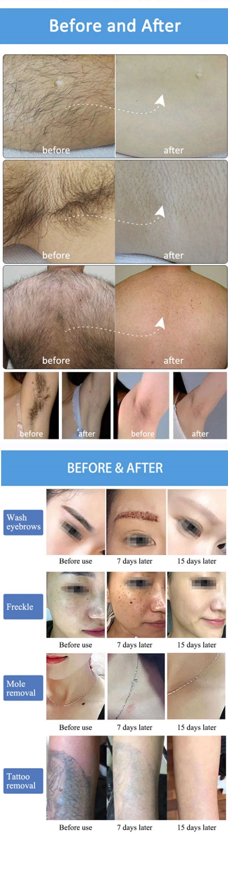 808 Diode Laser Hair Removal Machine 4-Wave Painless Permanent Portable 4000W Device  Soprano Titanium - Daisan Mart