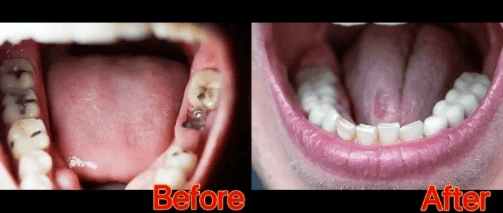Anti Decay Toothpaste repairs cavities, removes cavities, cleans plaque, whitens teeth, and freshens breath - Daisan Mart