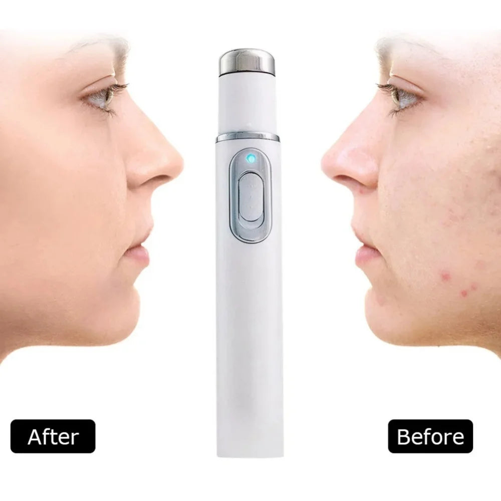 Blue Light Vibrating Eye Massager - Reduces Dark Circles &amp; Eye Bags