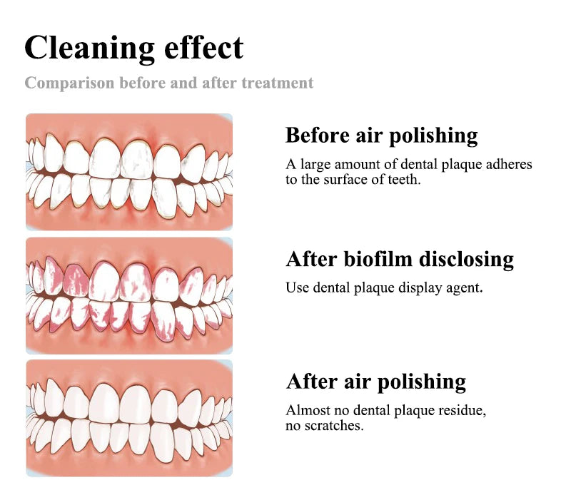 Tay Cầm Đầu Phun Khí Nha Khoa VV Cho Máy Đánh Bóng