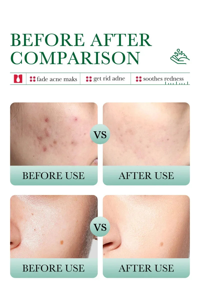 BIOAOUA Salicylic Acid Ance Removal Cleanser Fade Ance Marks Mild Moisturizing Soothing Facial Cleanser Face Washing Products