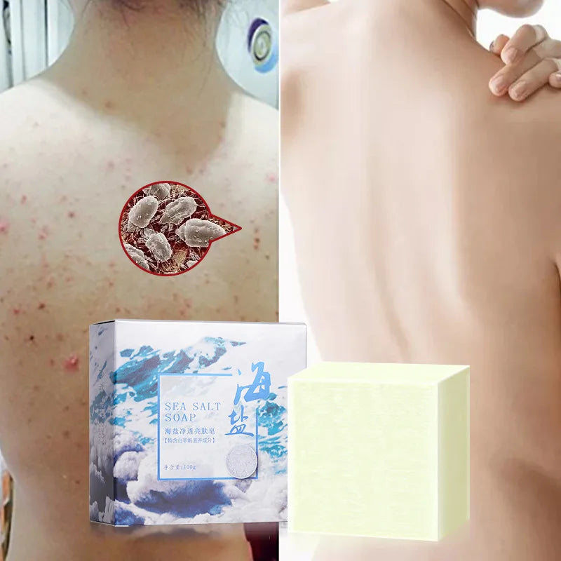 Sea Salt Body Acne Removal Soap Treatment Face Butt Back Acne Marks Smooth Repair Chicken Skin Moisturizing Whitening Skin Care