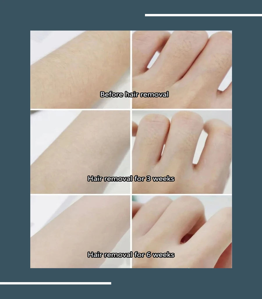 808nm 755nm 1064nmProfessional Portable 4000w Soprano Titanium Diode2025 Laser Hair Removal Machine High Power Alexandrite Laser - Daisan Mart