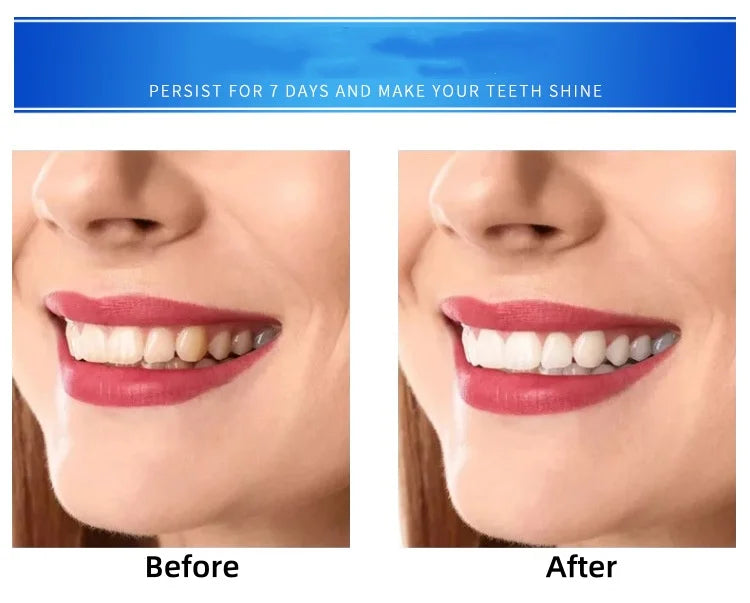 Teeth Whitening Set Cold Light Beauty Instrument Effectively Removes Yellow Tooth Stains USB Type Lamp