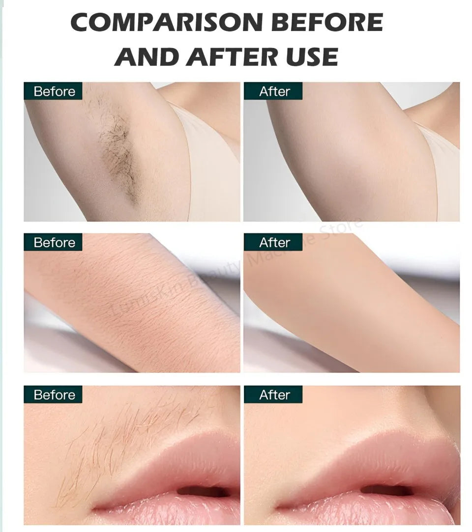 Painless Diode Laser Hair Removal Machine 755nm/808nm/940nm/1064nm 600W-1600W 60M Shots CE Certified For All Skin Types I-VI - Daisan Mart