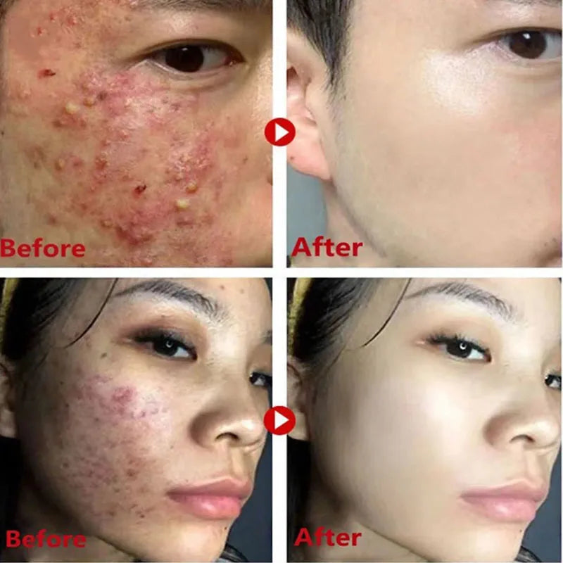 Green Tea Mask for Blackheads &amp; Pore Tightening