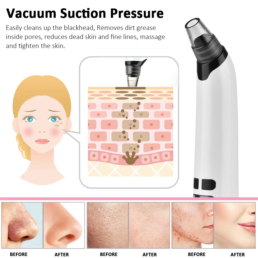 Blackhead Remover &amp; Home Skin Care