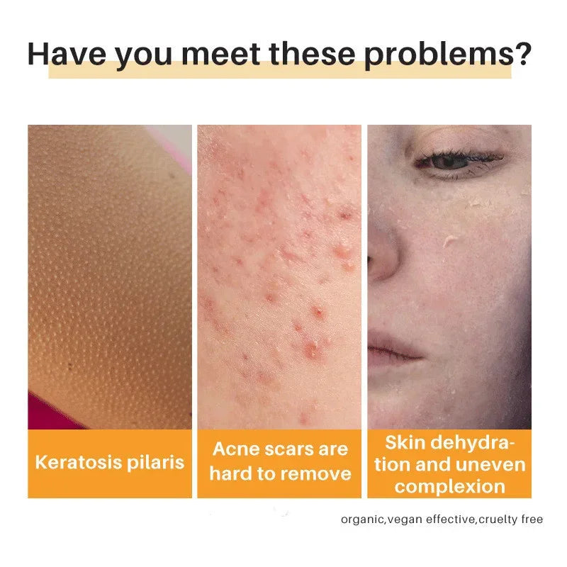 Sea Salt Body Acne Removal Soap Treatment Face Butt Back Acne Marks Smooth Repair Chicken Skin Moisturizing Whitening Skin Care