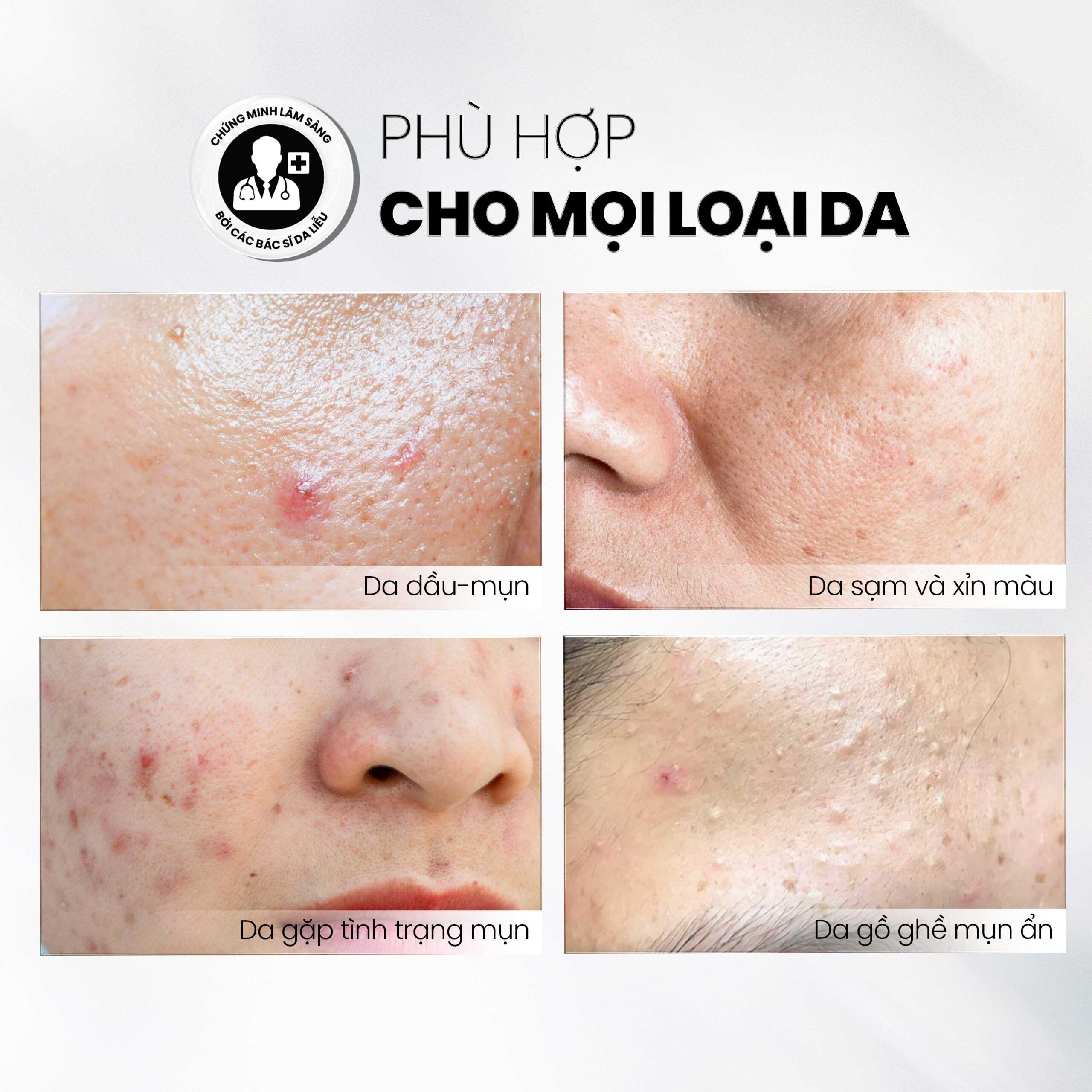 MD CARE AntiAc Exfo Chemical Exfoliant 30ml